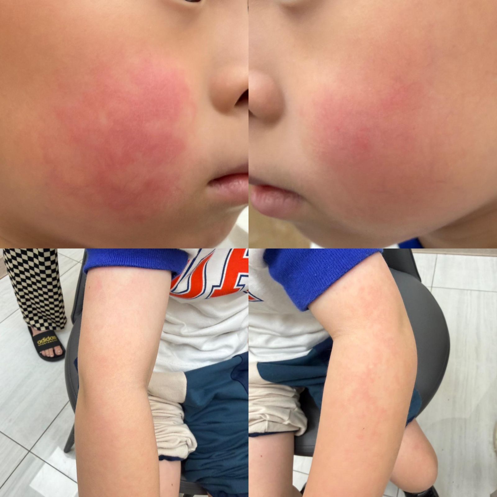 醫師指出，蘋果病紅疹通常出現於臉頰及手臂。圖／翻攝自顏俊宇臉書粉專