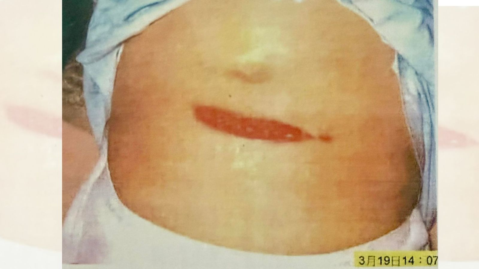 319槍擊案22週年　陳水扁再秀「鮪魚肚槍傷照」嘆：案子查到哪裡去了？