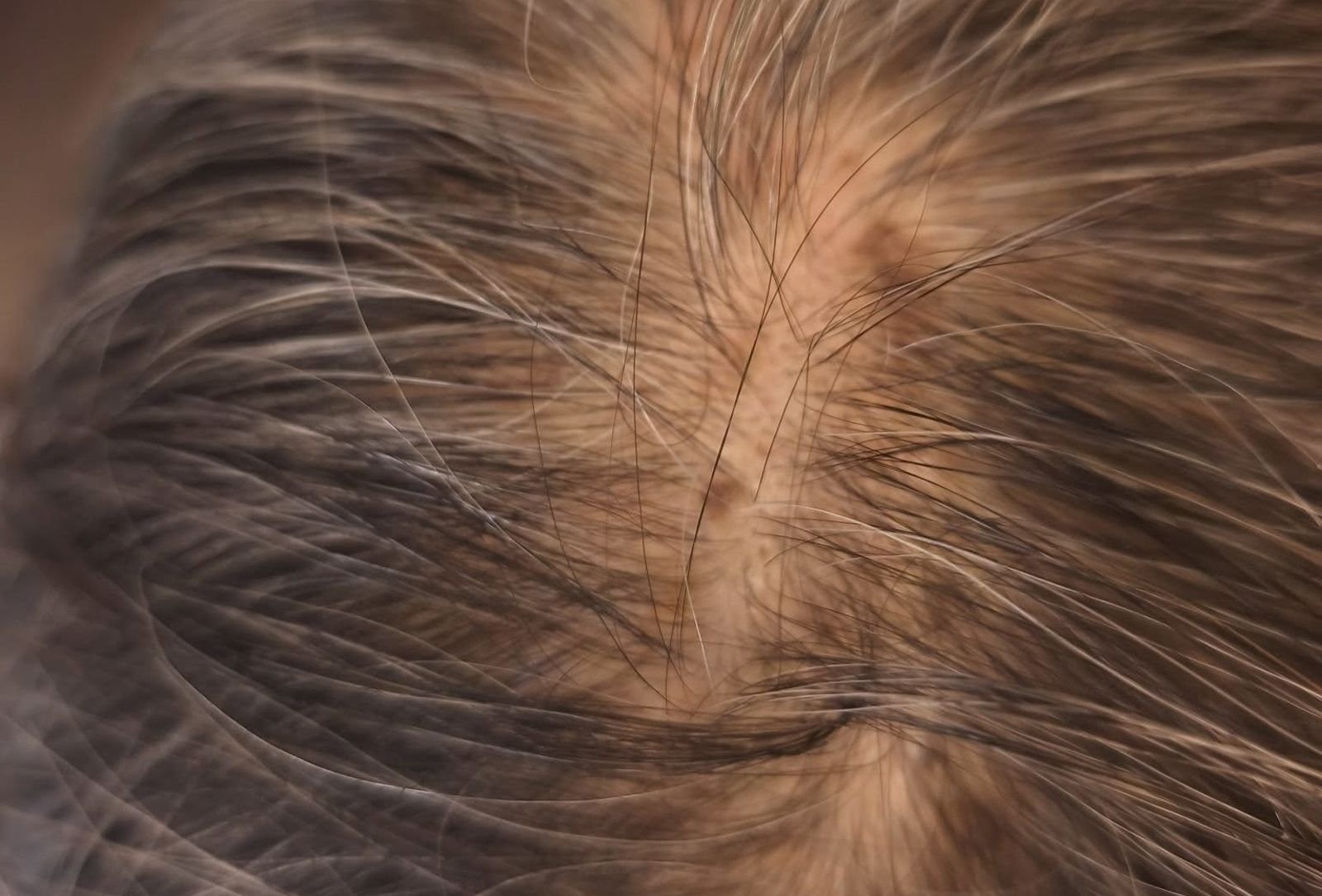 6旬婦頭頂長膿包露出一抹「螢光綠」　醫揪日常1習慣是元兇