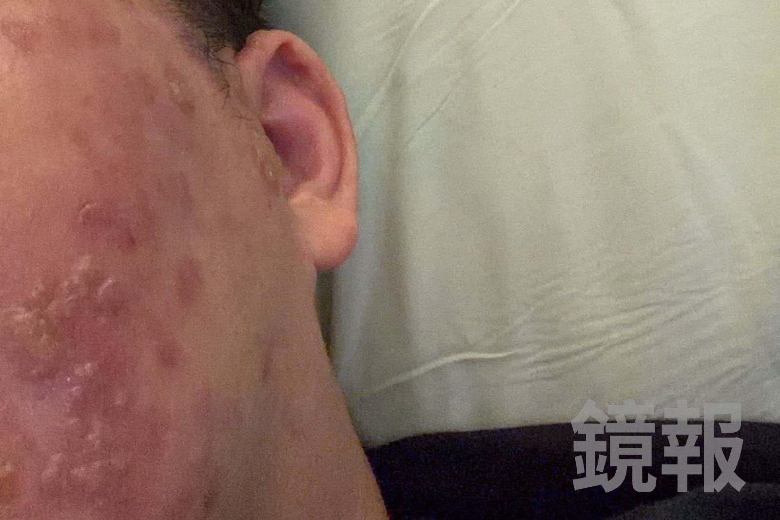 患者帶狀皰疹侵犯部位在頭部，導致嘴唇、臉頰及眼睛周邊都出現水泡症狀。亞大醫院提供