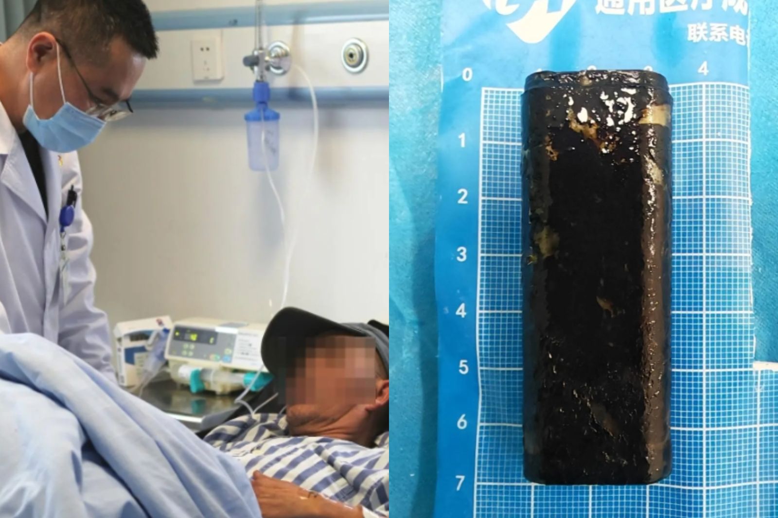 67歲翁腹痛照胃鏡！驚見「34年前打火機」：酒後打賭吞下肚