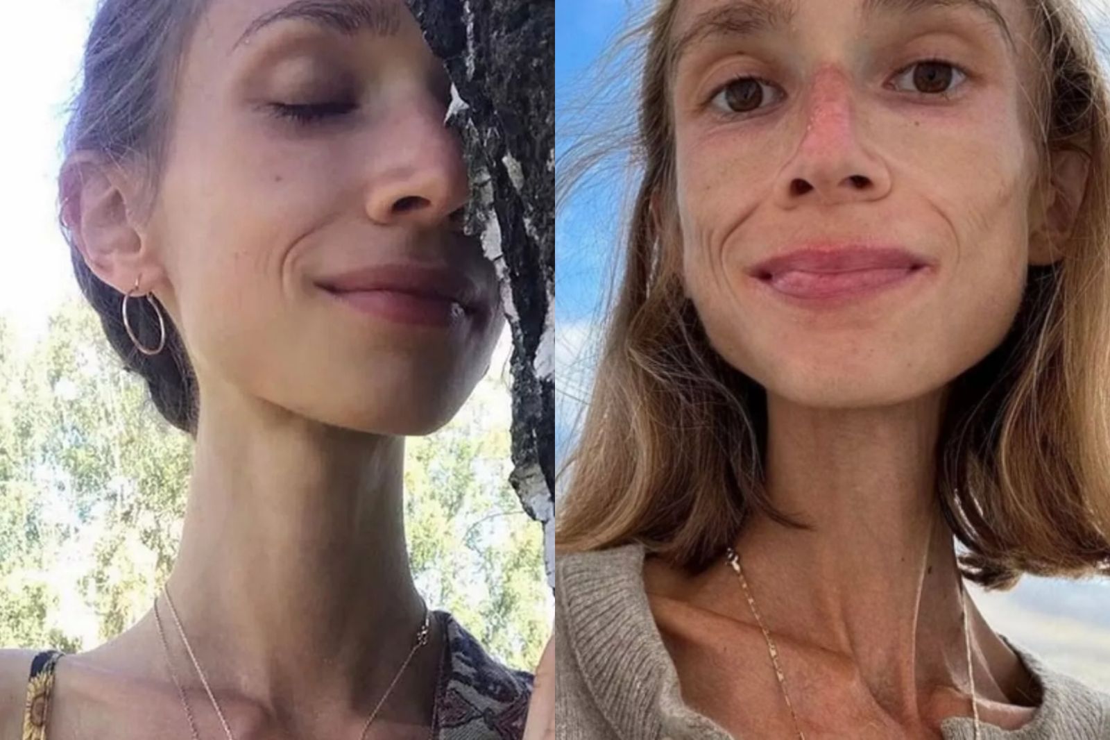 27歲女只吃水果過活!「瘦到22公斤」宛如骷髏 營養不良慘死