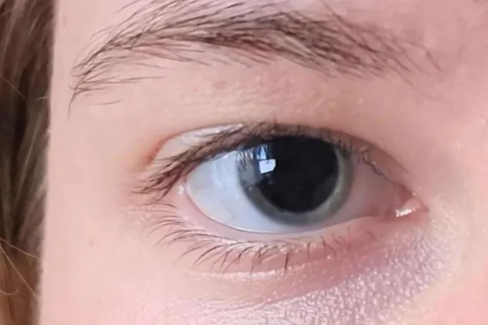 女上傳瞳孔照！醫一看驚喊「快去急診」：妳差點死掉