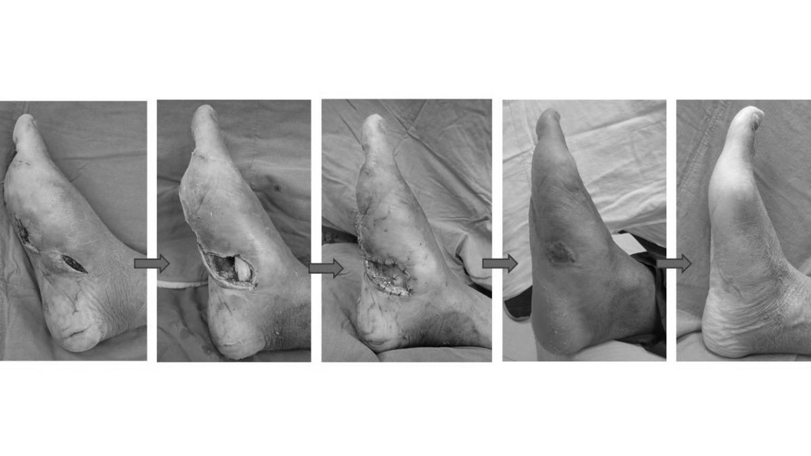 左腳差點截肢!中年男沒管破皮竟「潰爛壞死」…醫師教你分辨「傷口感染警訊」