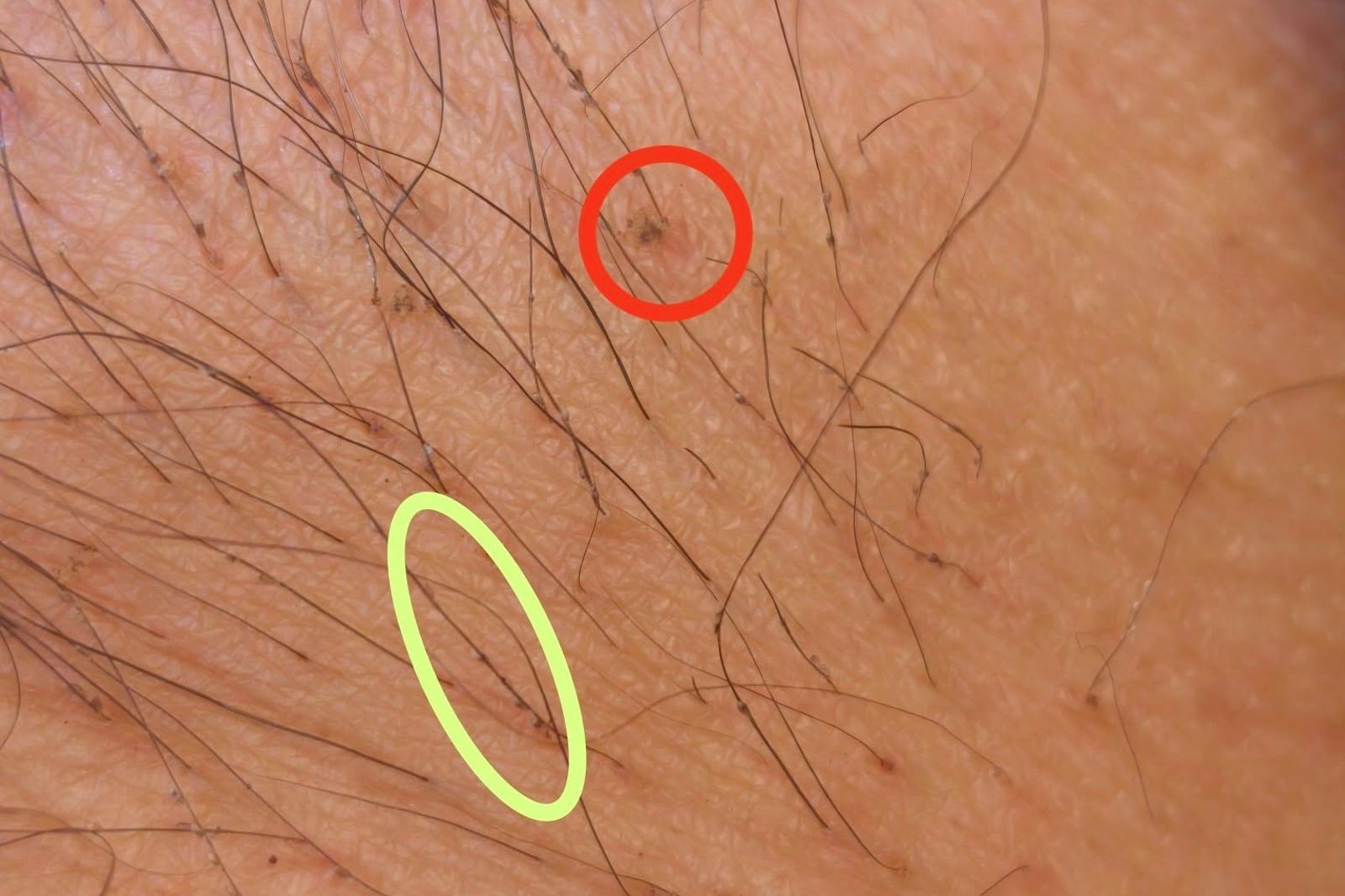 陰蝨附著於陰毛上。圖／皮膚專科烏惟新醫師