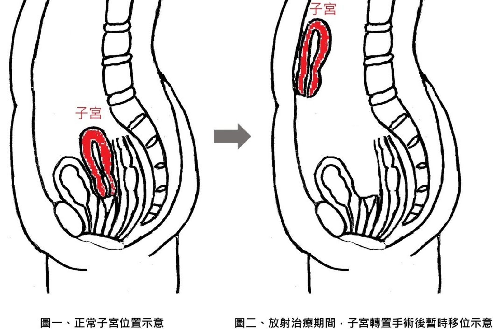 全台首例醫療奇蹟！23歲女罹直腸癌　靠「子宮轉置手術」保住生育希望