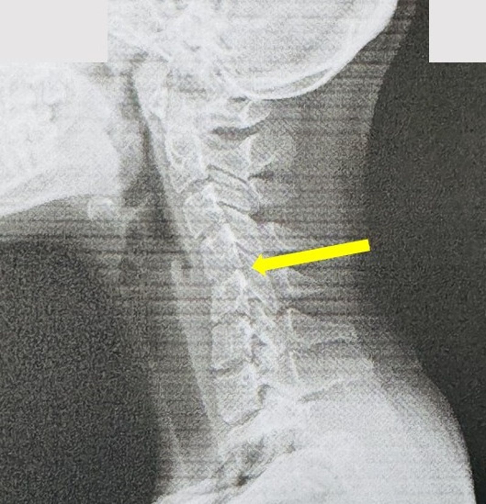 一名20女患者頸椎從C字形僵硬成直線。圖／翻攝自員榮醫院腦醫葉宗勳醫師臉書粉專