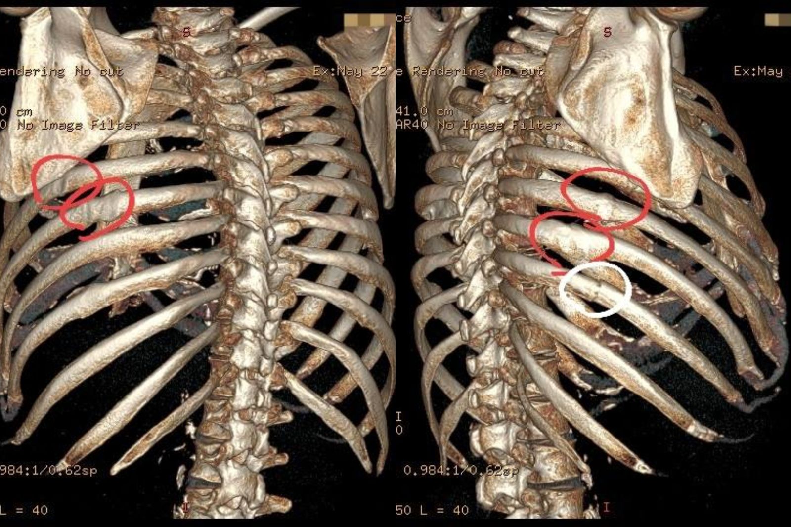 40多歲男咳一半胸腔「突發1怪聲」 醫檢查:肋骨斷裂