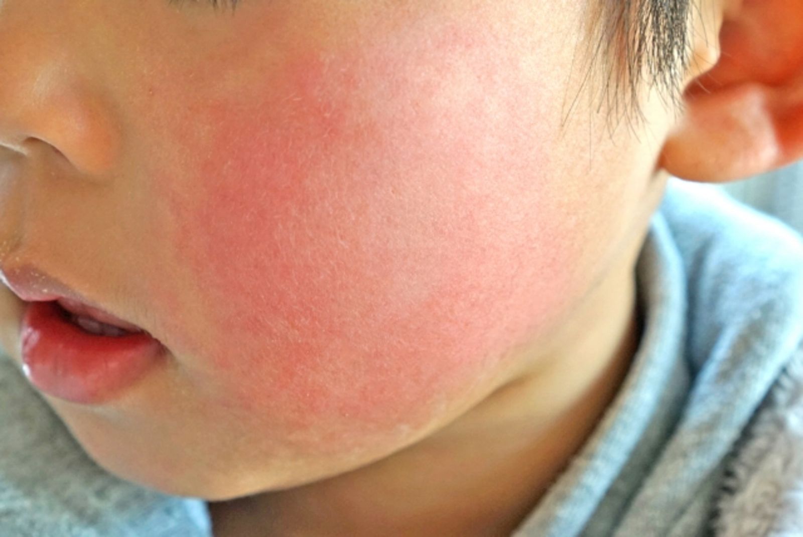 不是裝可愛！近期日返台「蘋果病」感染數增　醫示警3族群要小心
