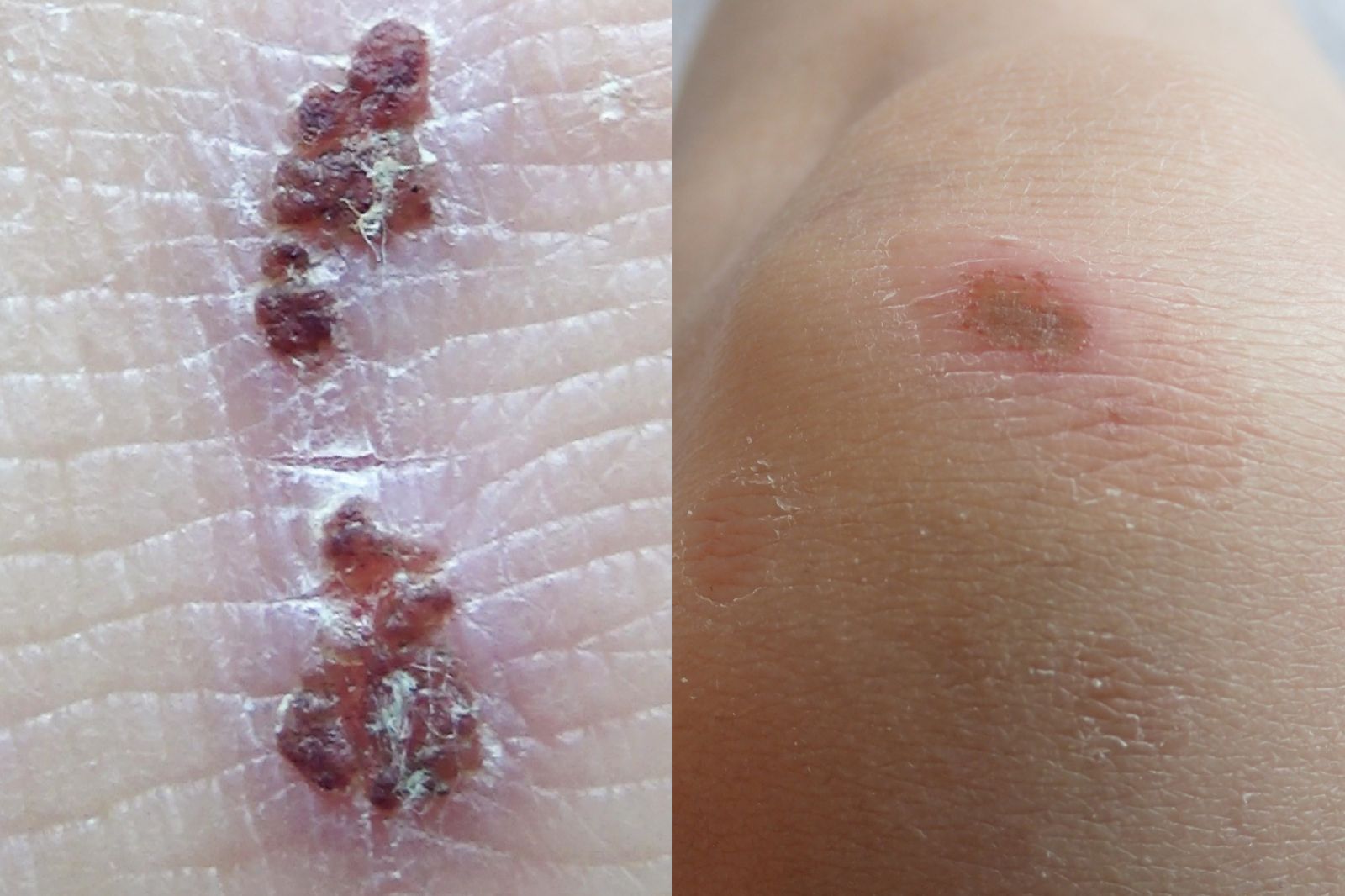 「傷口結痂」就是快好了？醫嘆：根本留疤元凶　這種疤需放療才能根除