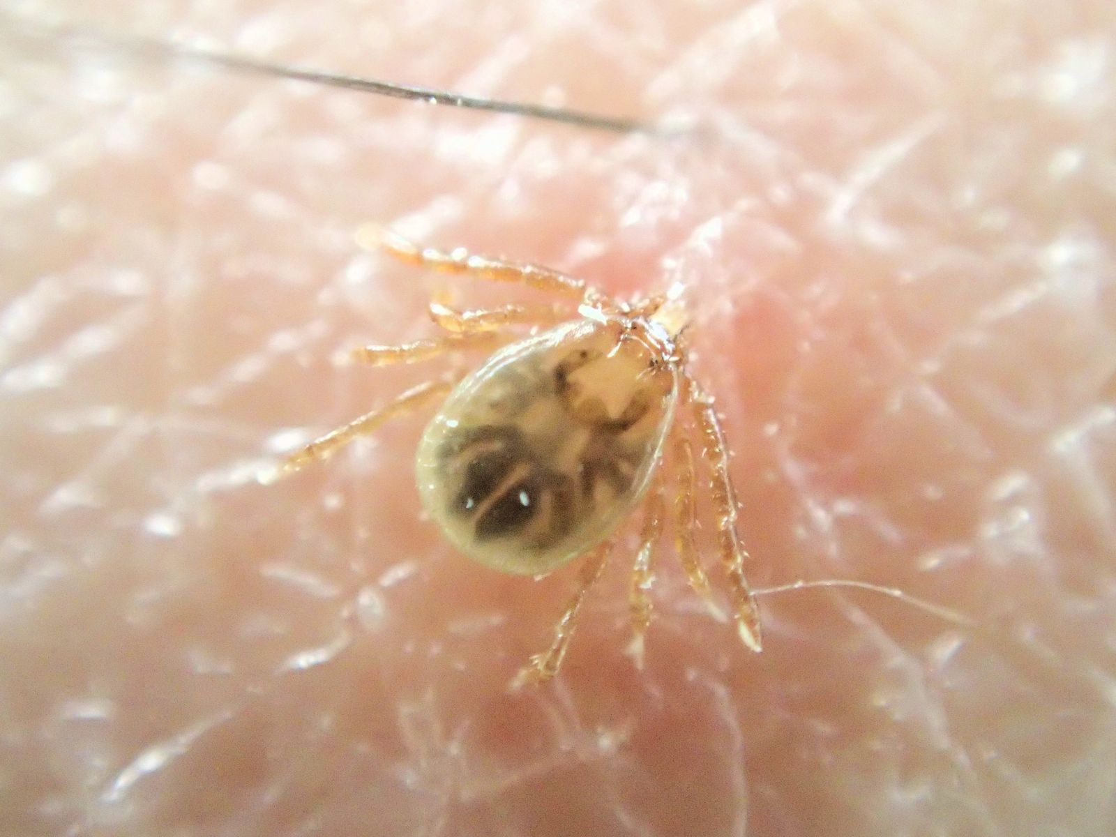 男童郊遊後「肚臍出現小黑點」 竟是「恐怖黑蟲」!醫:還好沒有拔起來