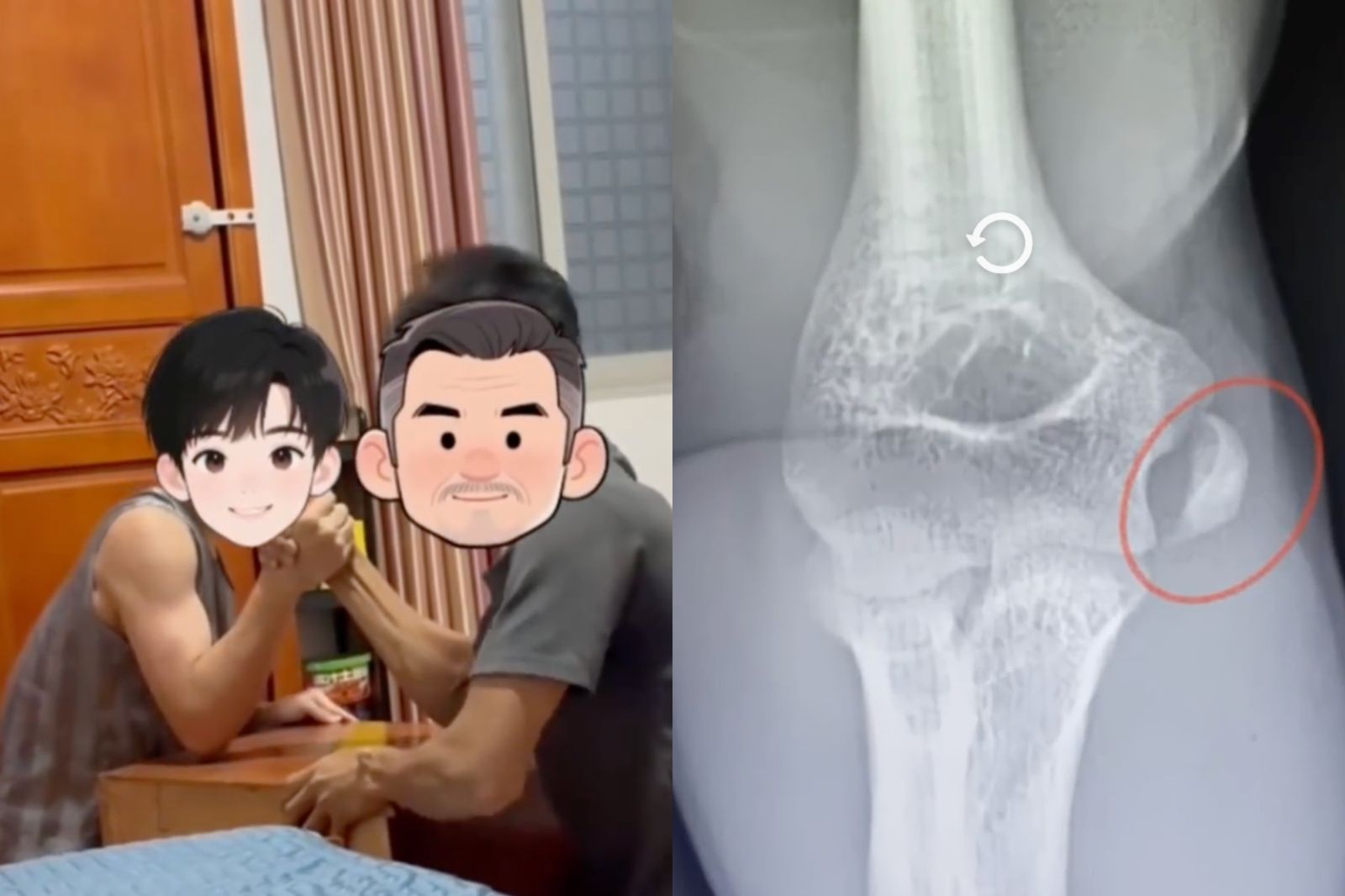 「完囉!」父子比腕力突然「喀一聲」...兒子手肘骨折緊急送醫