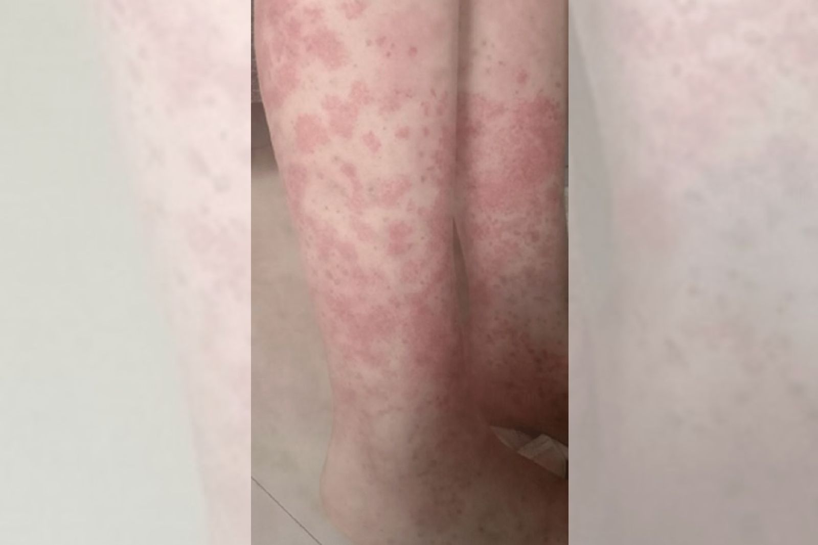 年輕女連續2年每月都染髮！「全身冒紫斑」剃光頭保命