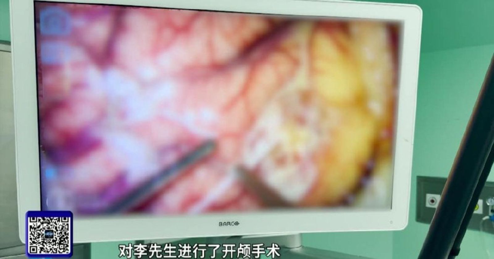 手術中醫生找到了這條寄生蟲。圖/翻攝DV現場