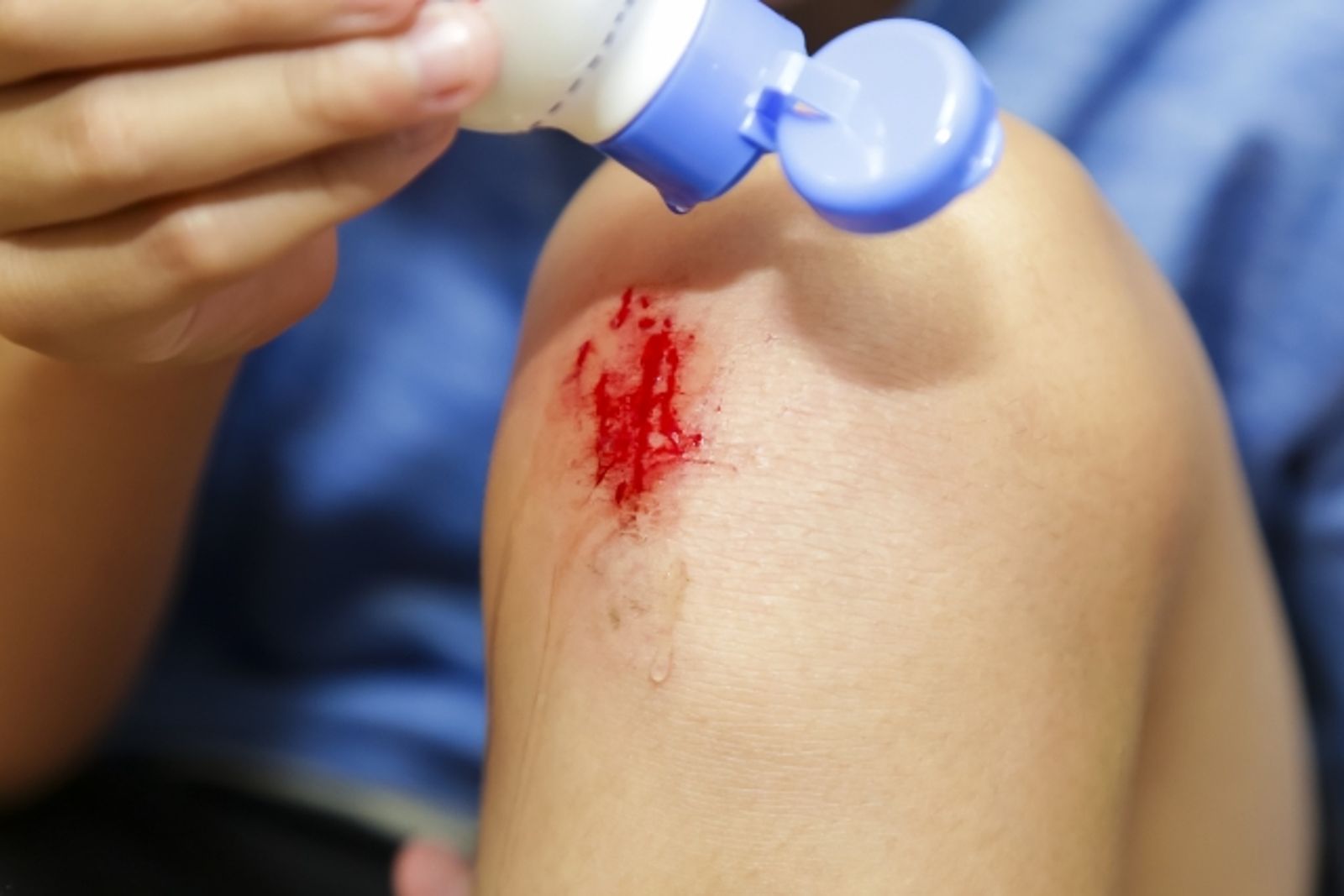 結痂好的快？醫曝「這療法」傷口癒合快2倍、不留疤　
