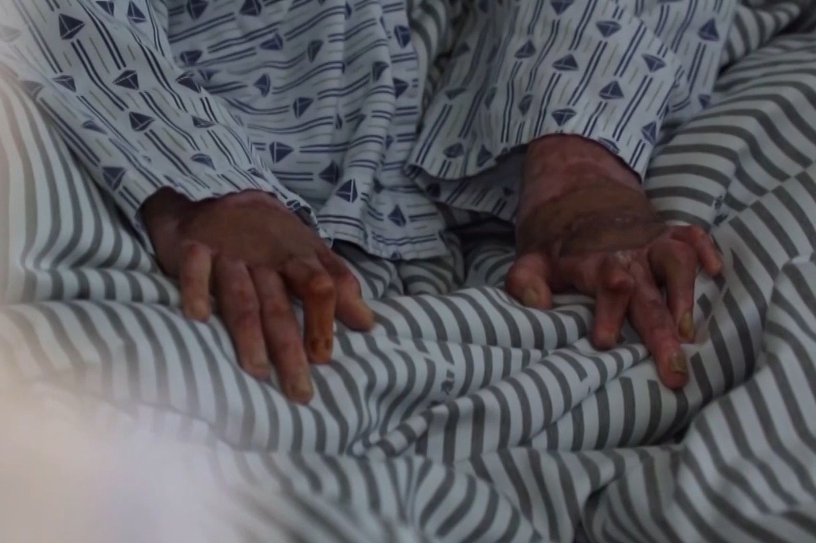 中國青少年因為丁烷爆燃導致身體嚴重燒燙傷、手指無法彎曲。圖/翻攝自微博