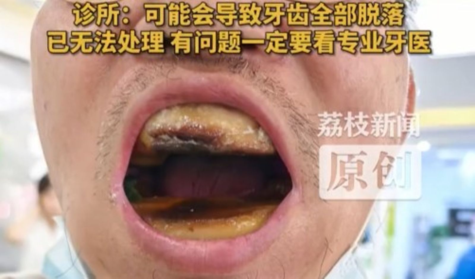 男子自行用樹脂補牙。圖/翻攝自微博