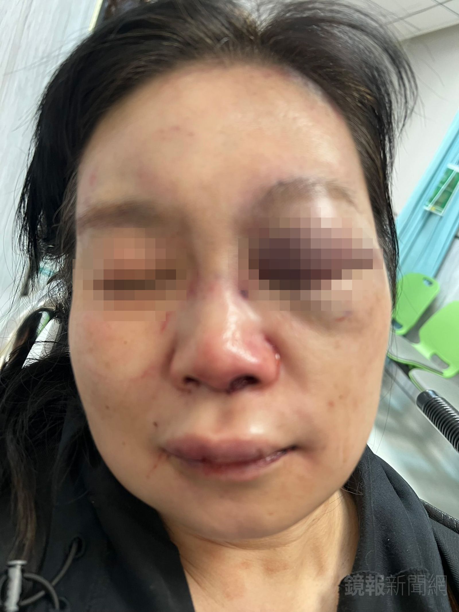 沈醫師左眼處骨折,鼻樑粉碎性骨折,門牙斷了2顆,頭部至今仍持續腫脹。