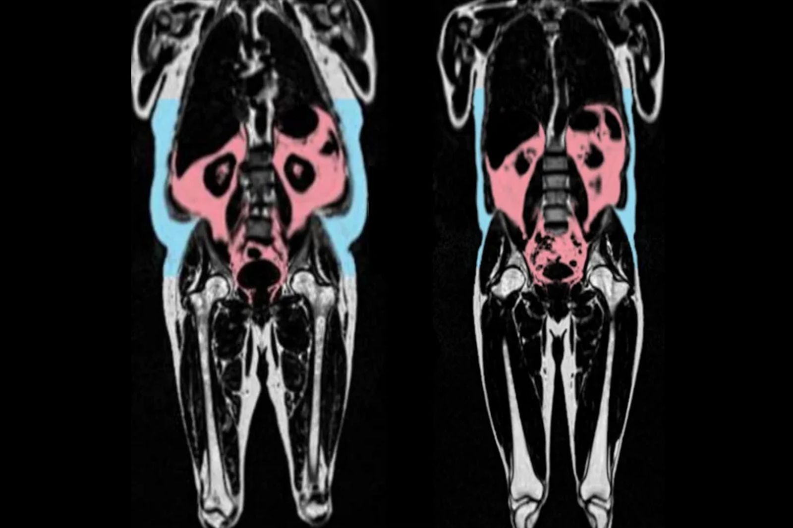 隱藏脂肪影響健康！研究曝「這類」常見體型最容易衰老