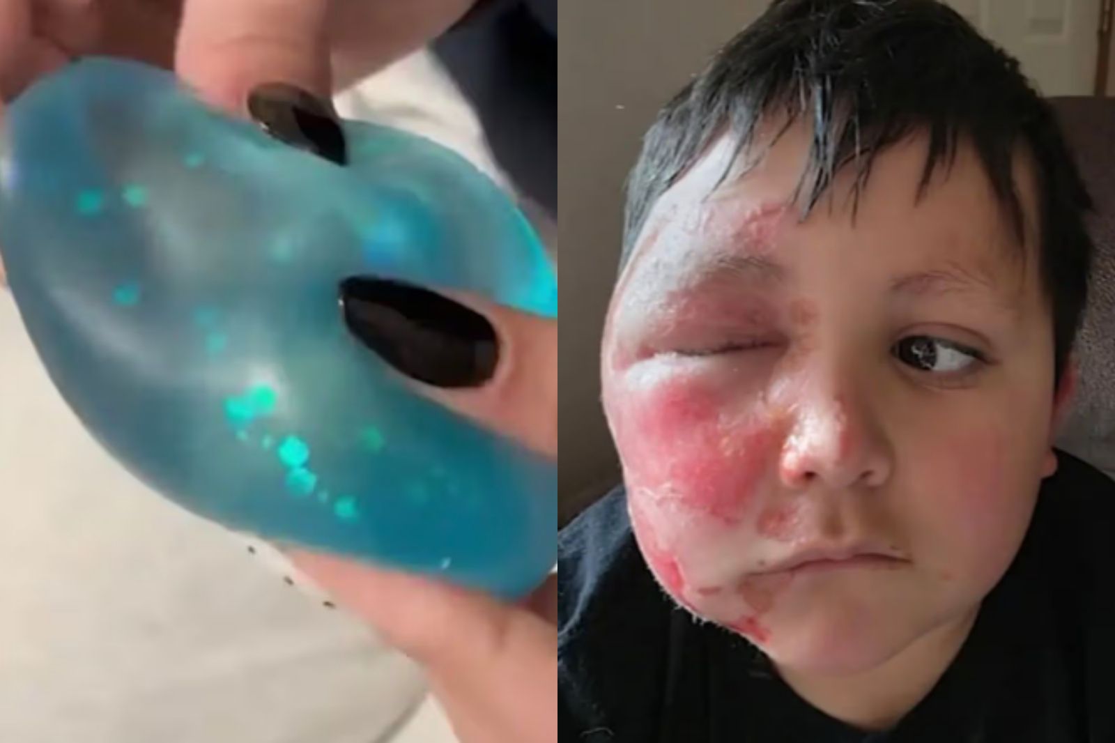 千萬不要學！9歲男童模仿抖音微波玩具...瞬間爆炸「右臉融化」險失明