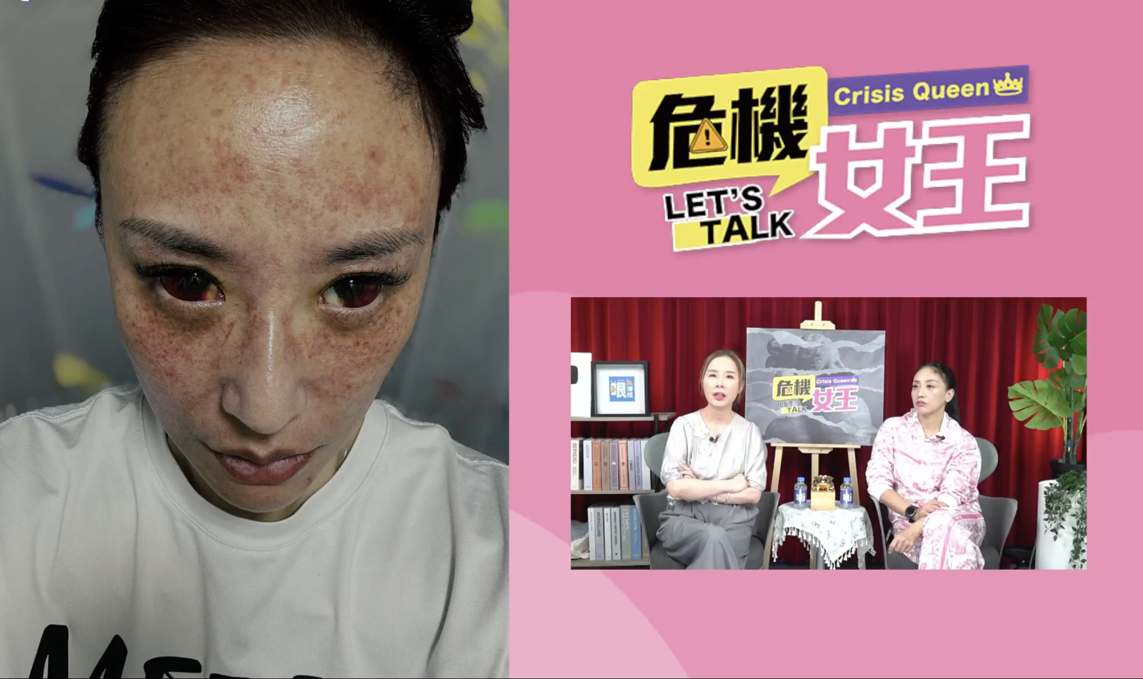 國手老公外遇、家暴！安歆澐發不自殺聲明　遭掐脖缺氧暈厥、全臉爆血管傷照曝光