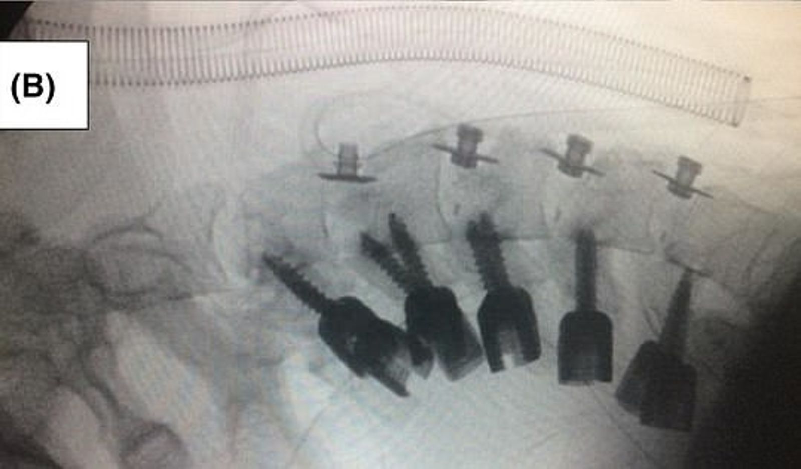 醫師透過手術「鎖住」男子變形的頸椎骨骼。圖／翻自《每日郵報》