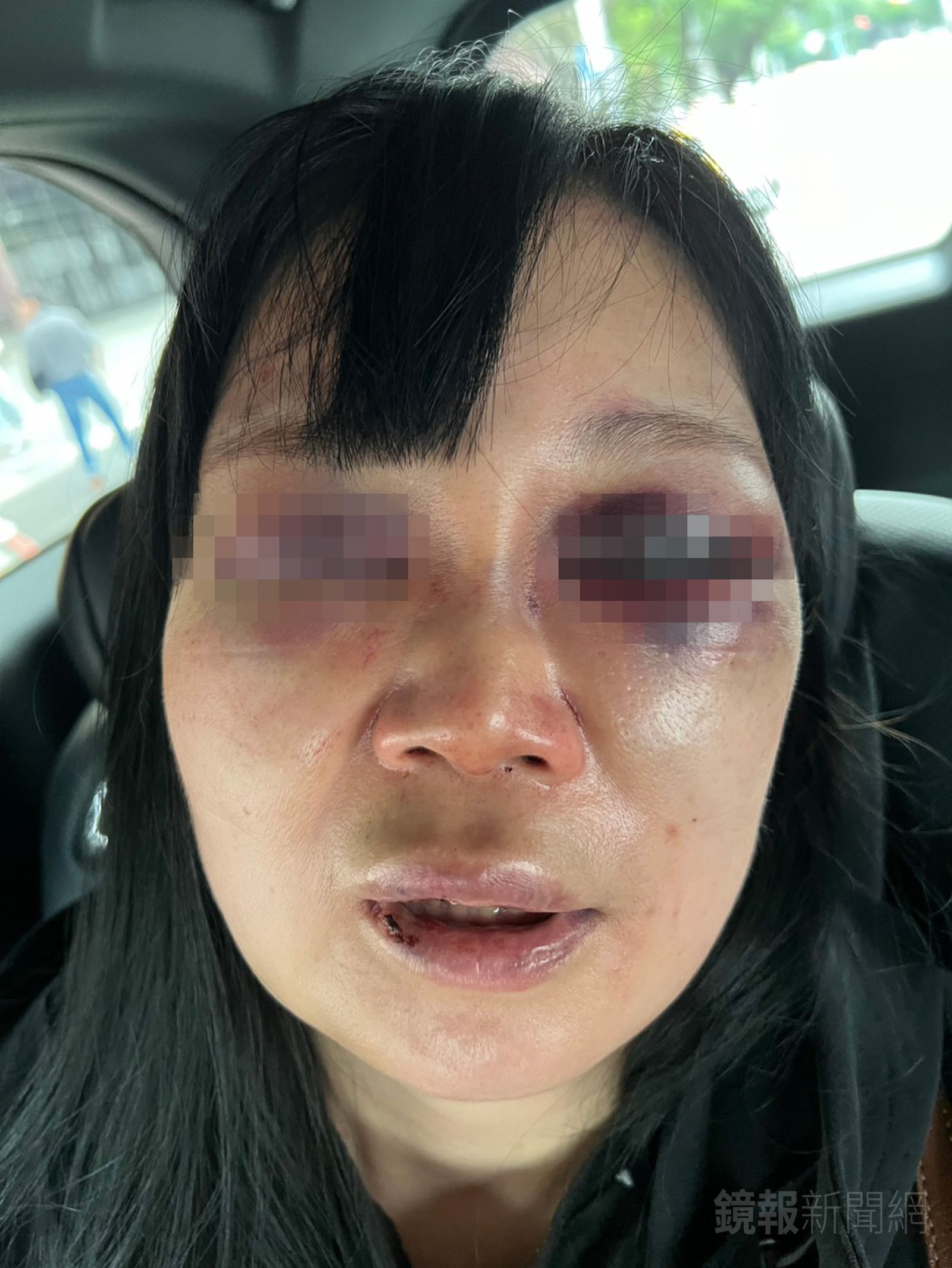 女牙醫被打到雙眼嚴重瘀青、臉部紅腫變形。