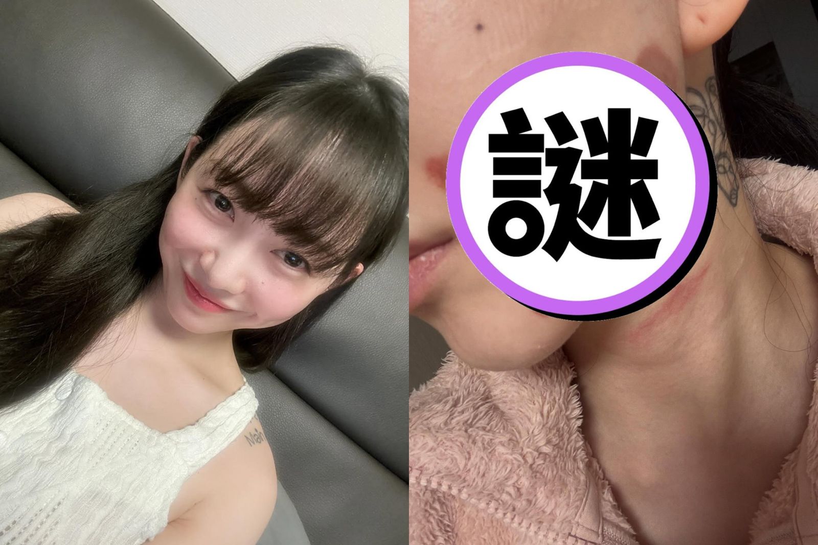 韓女星「做醫美慘遭毀容」！臉部10%深二度燒傷　權珉娥痛訴：皮肉像紙一樣剝落