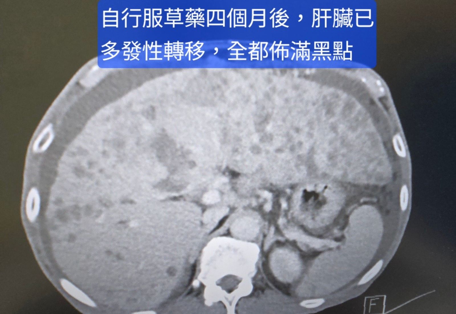 男肝癌拒醫更信草藥！自豪20年前救過命　4個月後急診後悔認「壓不住」