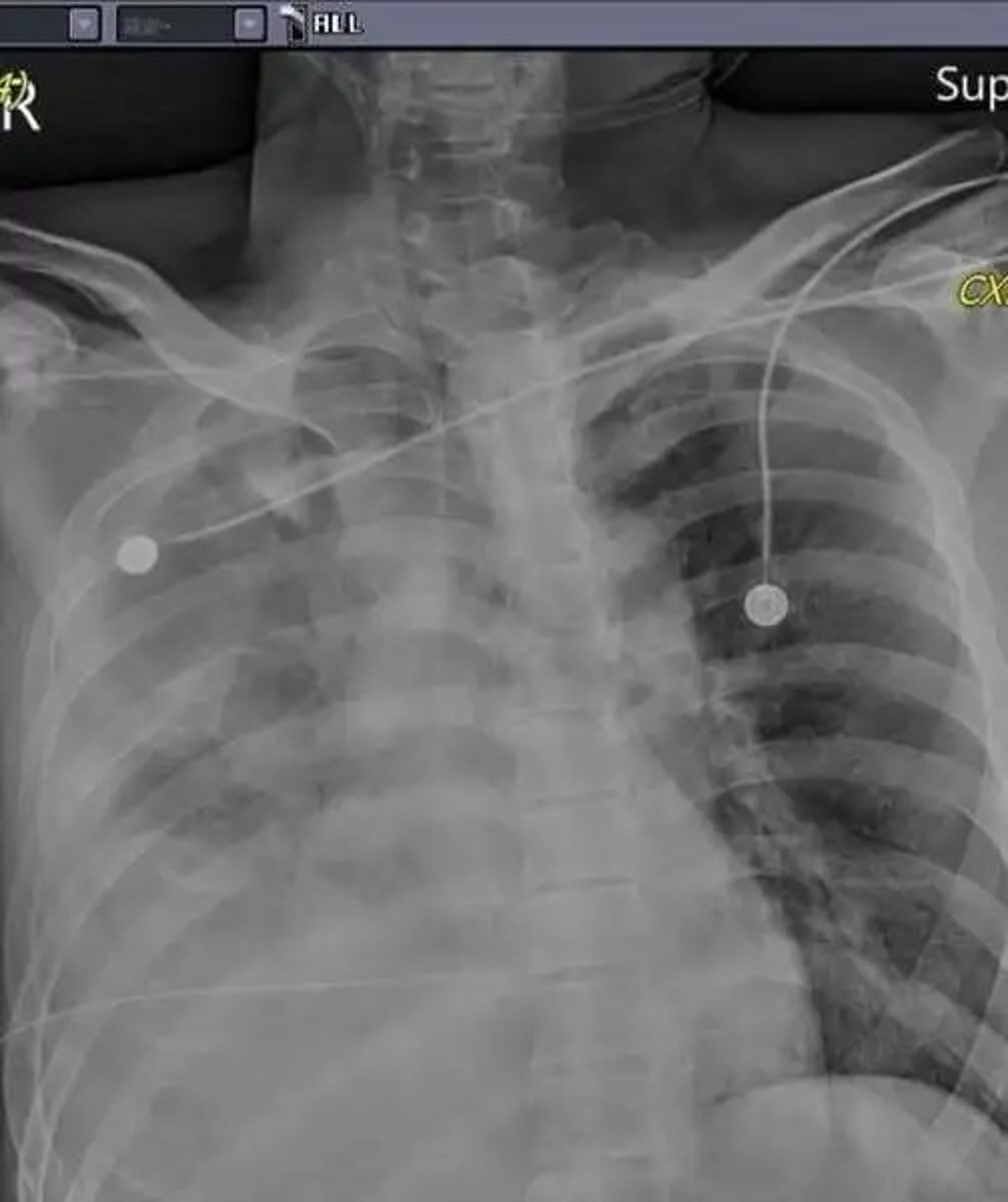 苗栗隨機殺人案被害人胸腹背三刀「肺、肝破裂」大出血　醫師：有那麼大仇恨嗎？