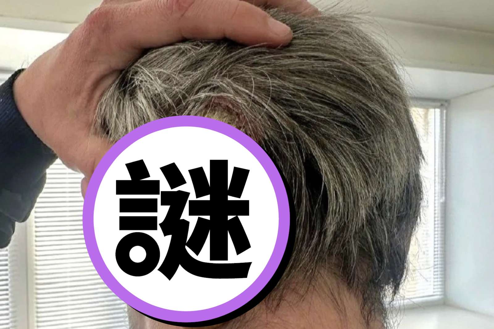 俄男後腦冒出12公分「惡魔角」　醫：25年來首例