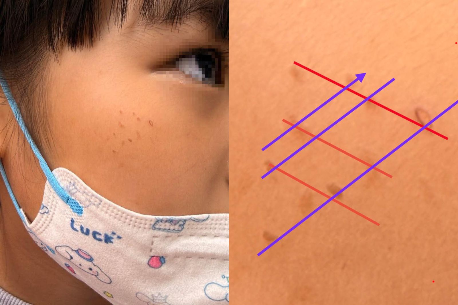 女童紅疹反覆發作找不到原因　醫師揭關鍵：太規則了