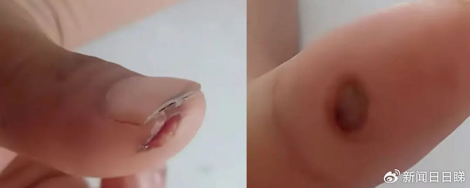 早餐店老闆手指被燒傷。圖／翻攝自微博／大象新聞