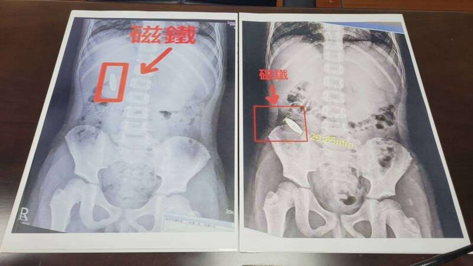小一生遭「學長」強逼吞3公分磁鐵　補習班疑包庇「監視器剛好壞了」