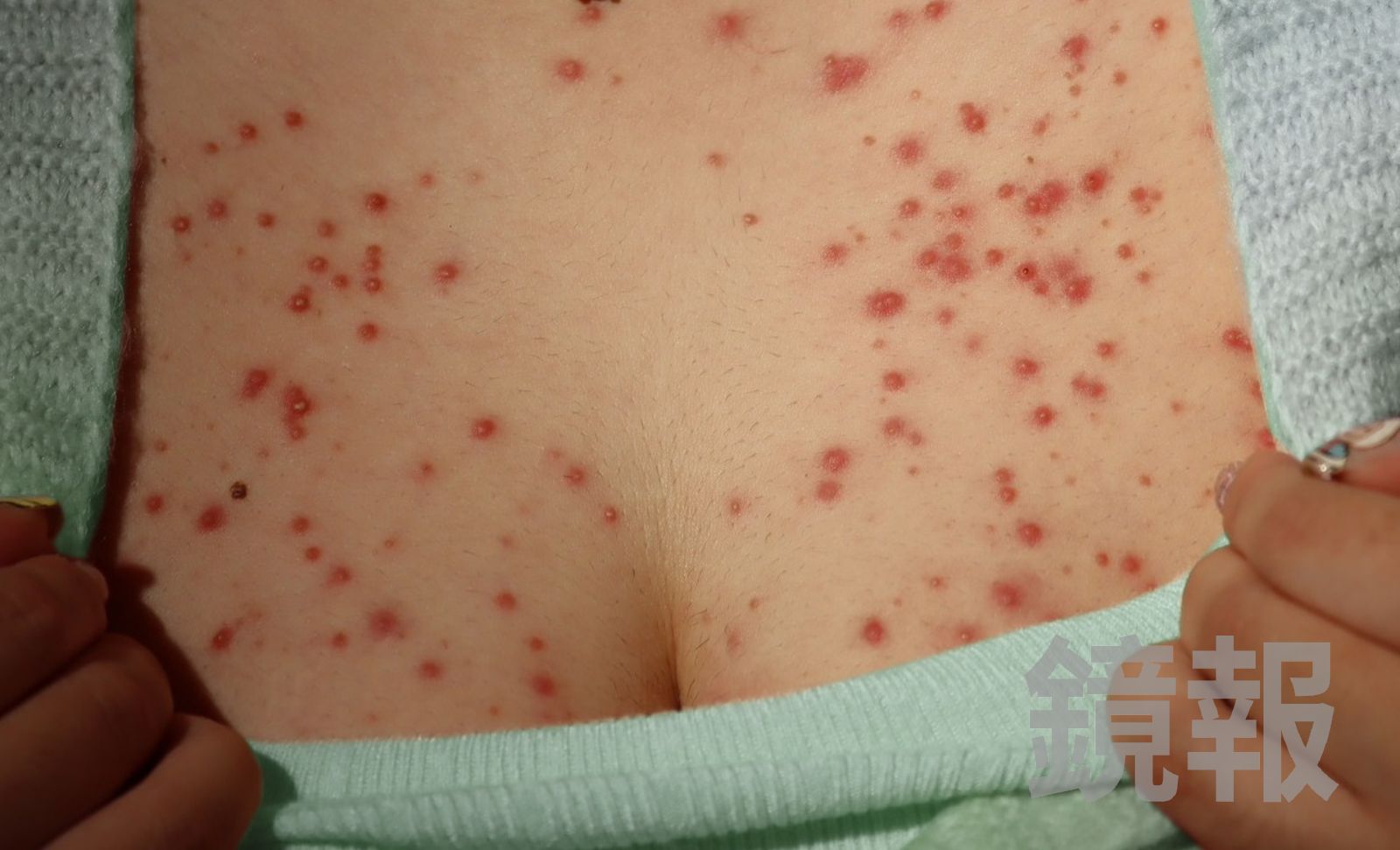 美女白皙酥胸慘變「紅豆冰」 濕疹誘發毛囊炎原因曝