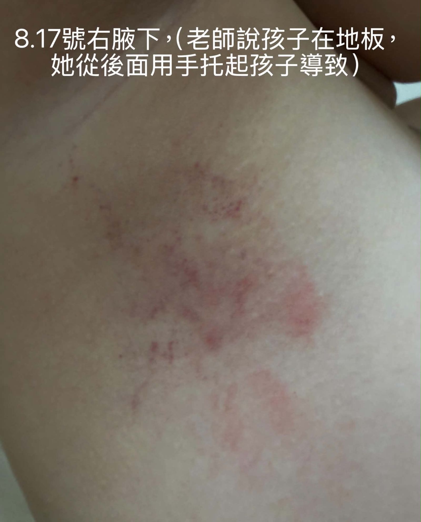 女童腋下傷勢。家屬提供