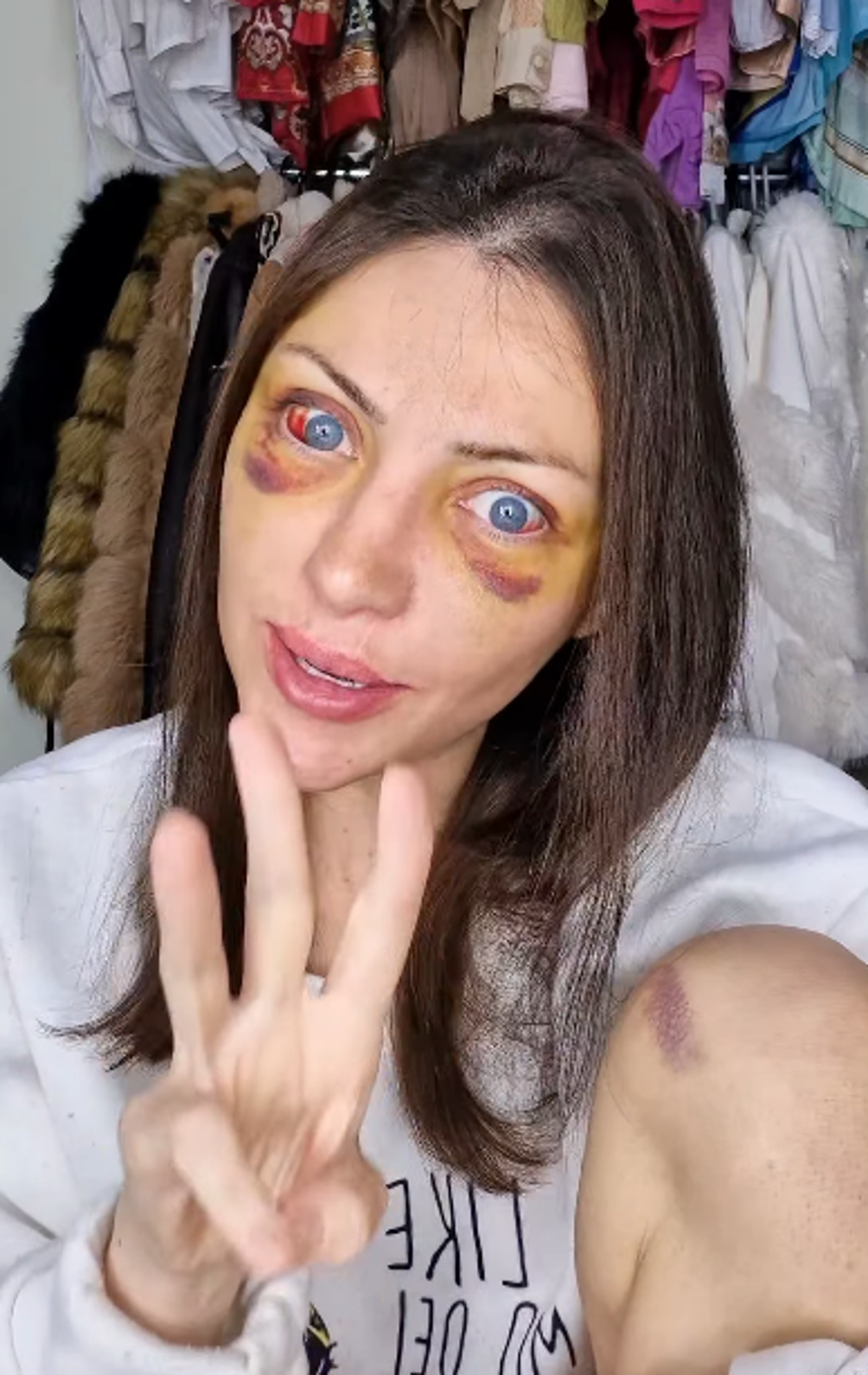 揚卡夫斯基曾整形27次,更公開自己拉皮手術後的照片。圖/翻攝自當事人IG