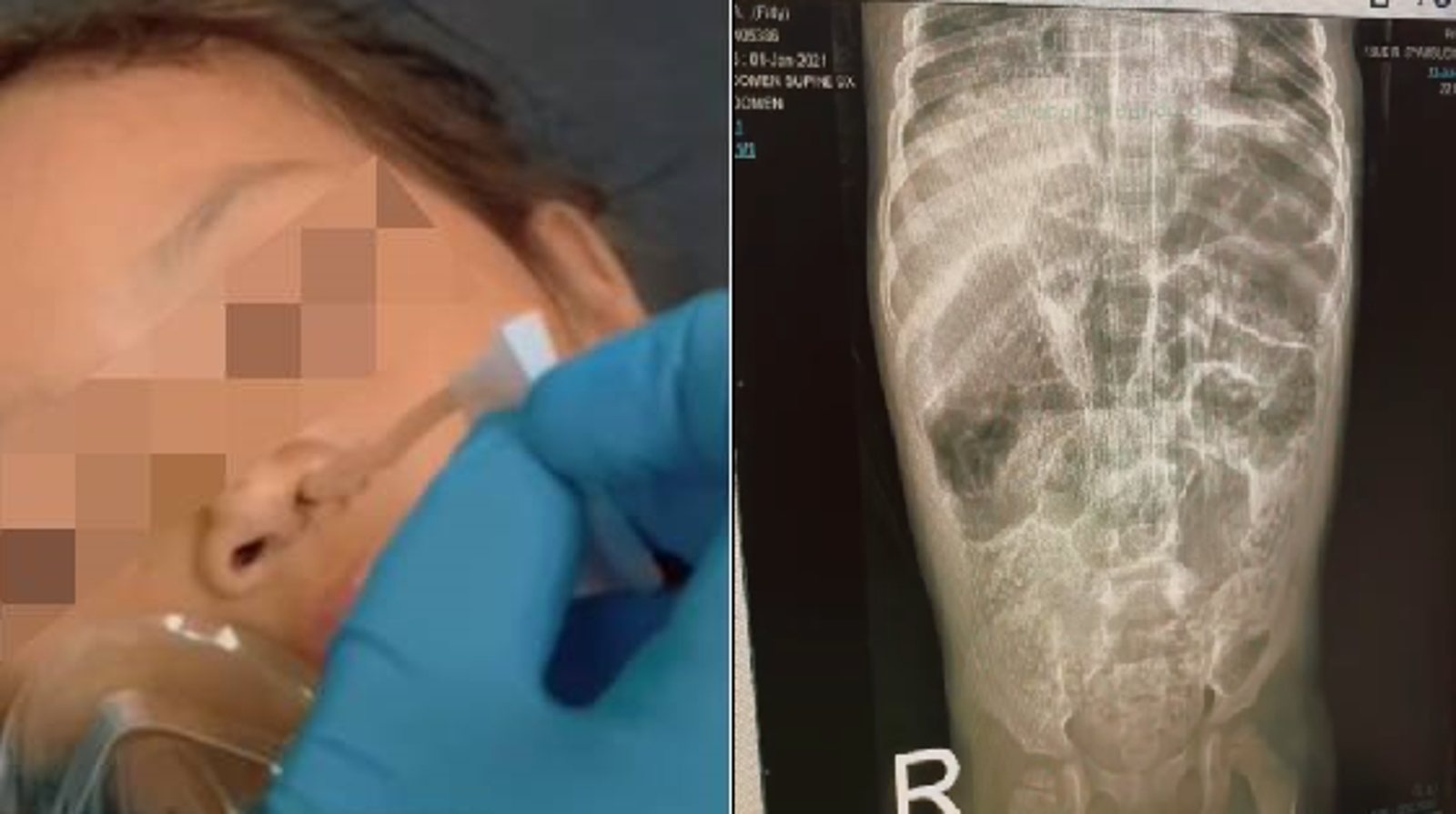 印尼弱勢4歲童嚴重蛔蟲感染入侵腦部　鼻子抽出15公分活蟲病逝