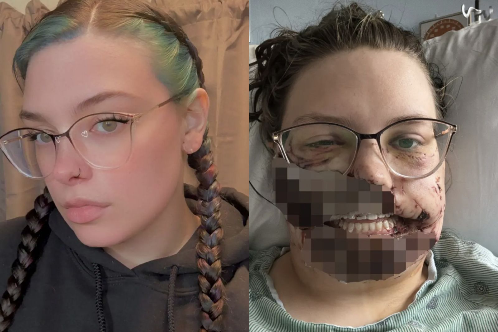 養4年比特犬暴走！她在家昏倒遭撕咬「臉幾乎全毀」　清醒崩潰：把我臉吃了