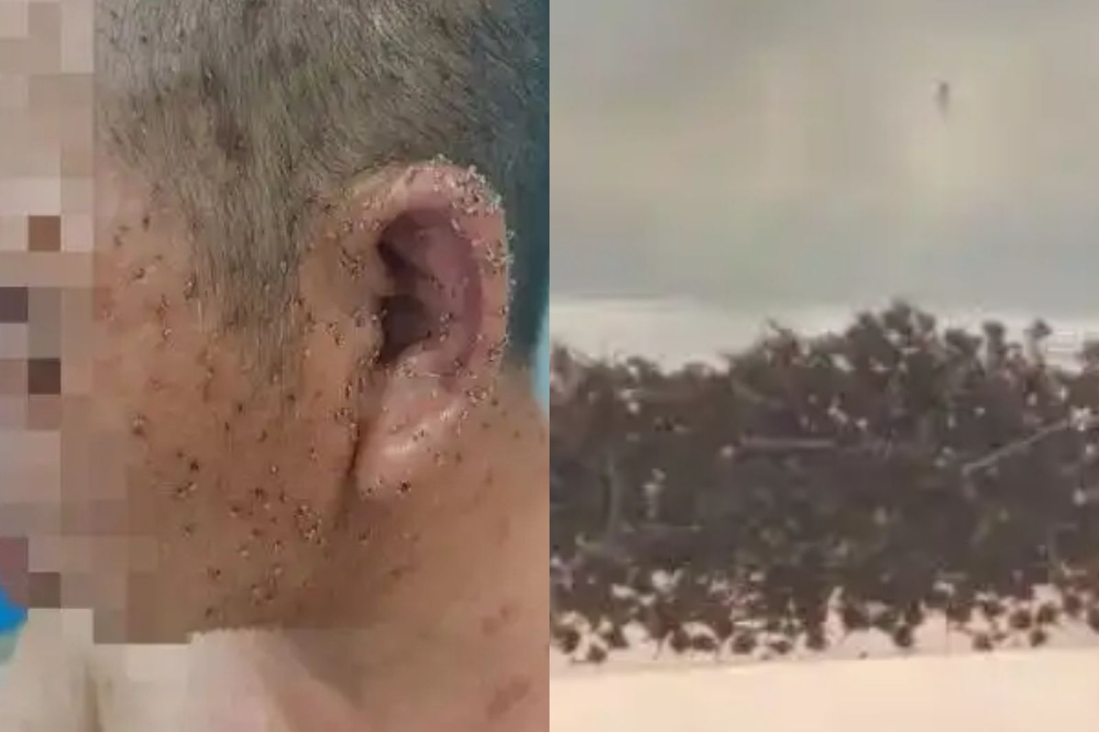 恐怖!男子遭蜜蜂「圍攻」全身被扎上千根毒刺 醫師「拔刺3小時」救命
