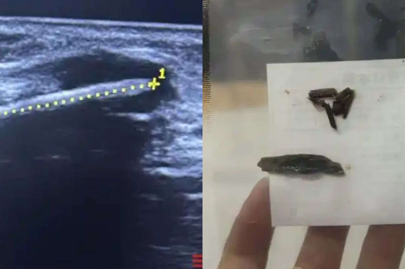 走路小腿就痛！X光一照「竹籤插體內16年」　女：想到就怕