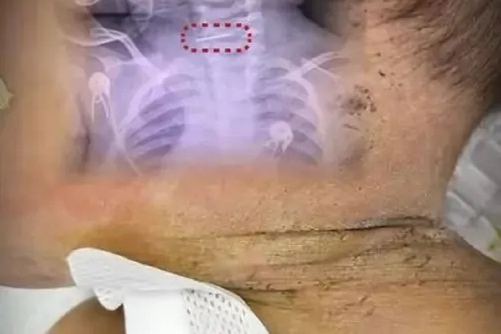 感冒、不聽話就扎針！10個月大男嬰遭母刺出上百針眼　當局揭真相