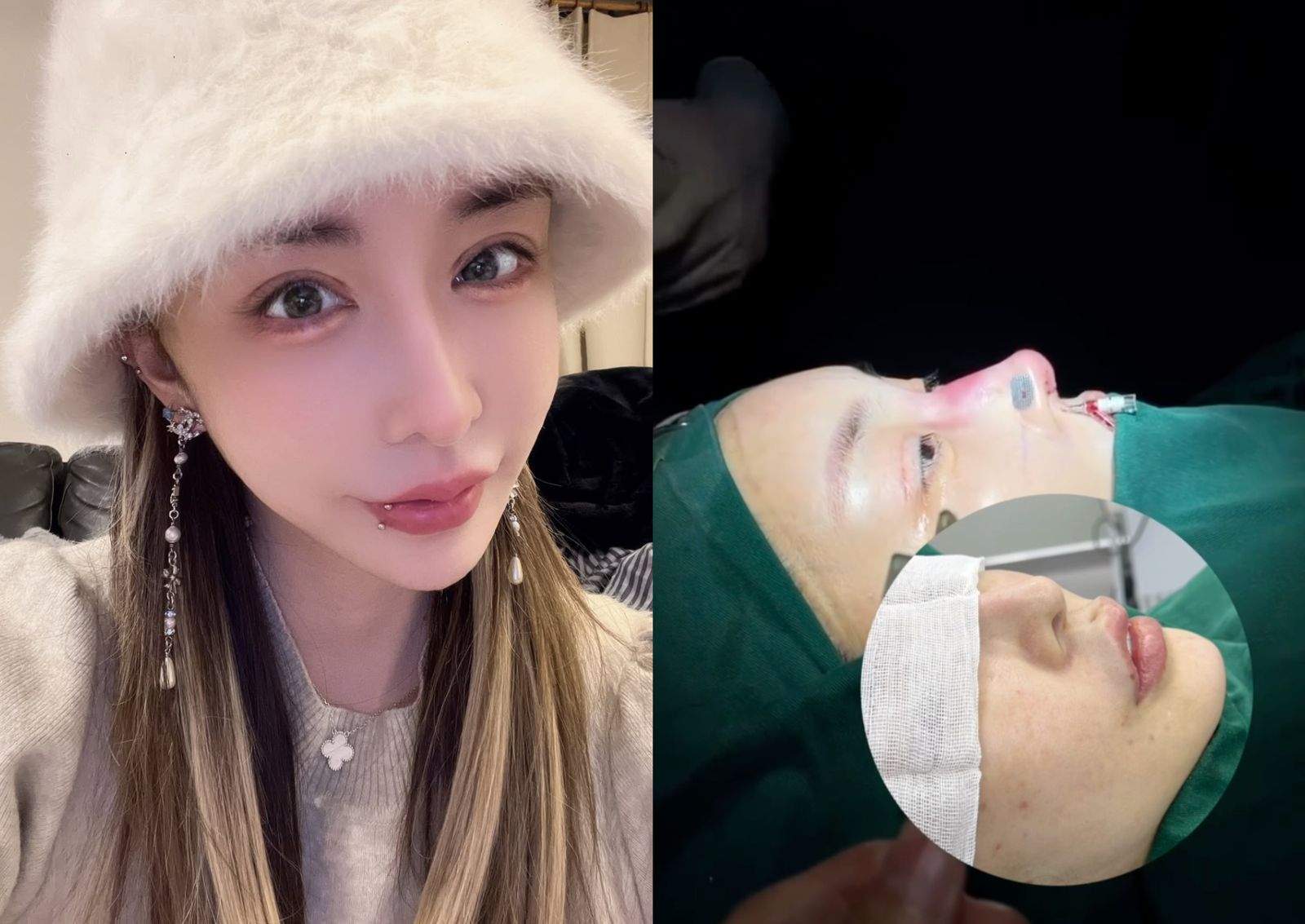 雪碧整形最新近照曝光!術後10天拆線 告別12年假鼻子「有點上岸了」