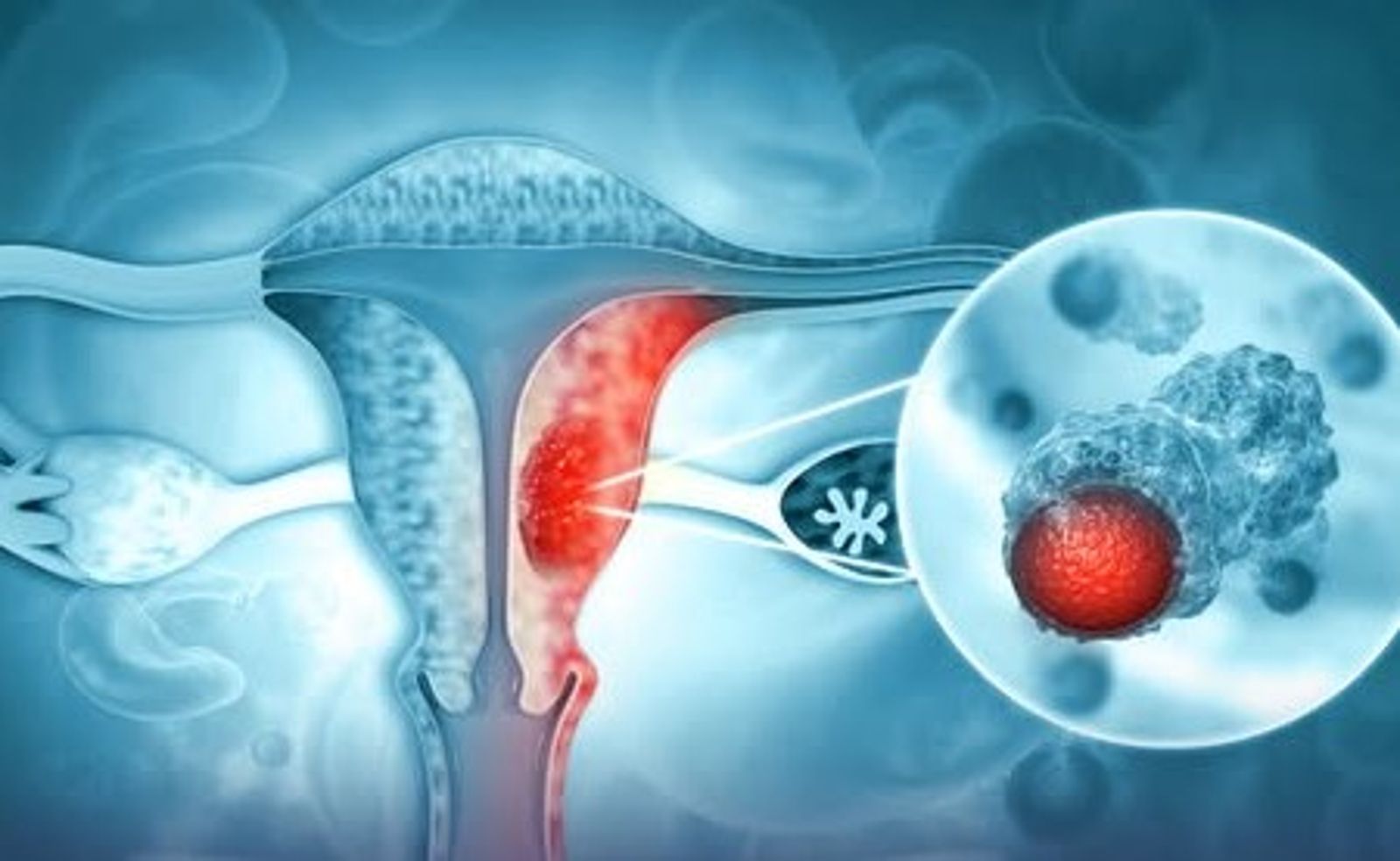 在卵巢癌、輸卵管癌及原發性腹膜癌治療中，含olaparib合併bevacizumab具治療效果，甚至olaparib被列為乳癌首選治療方案藥物。（翻攝阿斯特捷利康臉書）