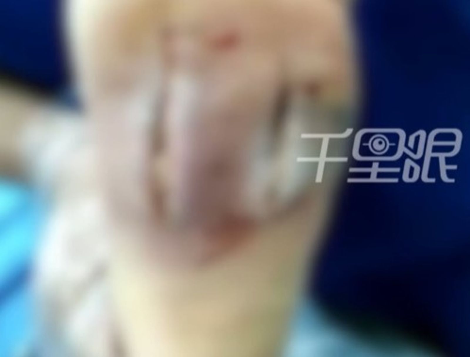 小孩感染創傷弧菌險喪命。圖／翻攝自微博