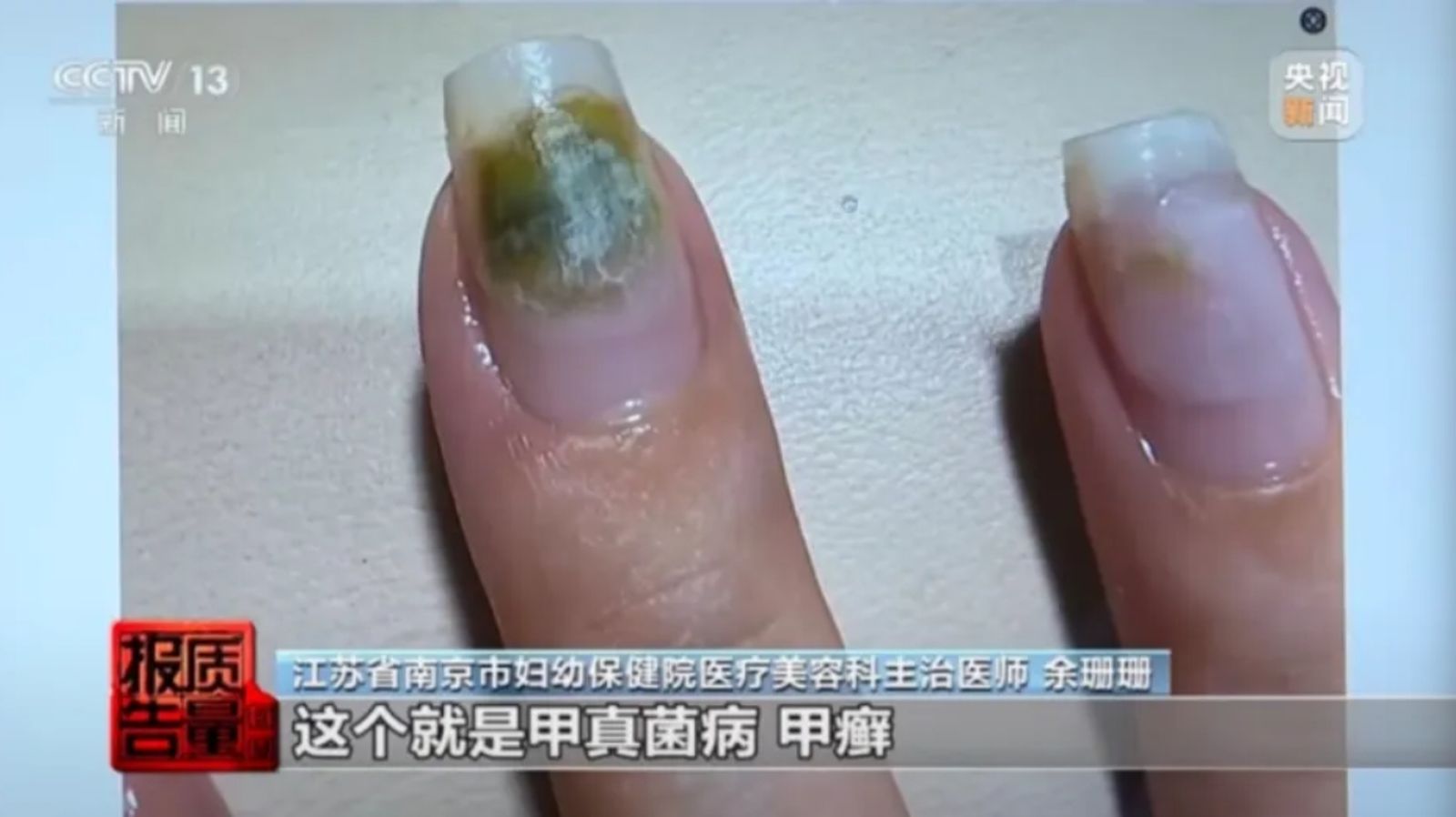 愛漂亮做美甲 女子竟「感染菜花」!醫釋疑:一習慣造成的