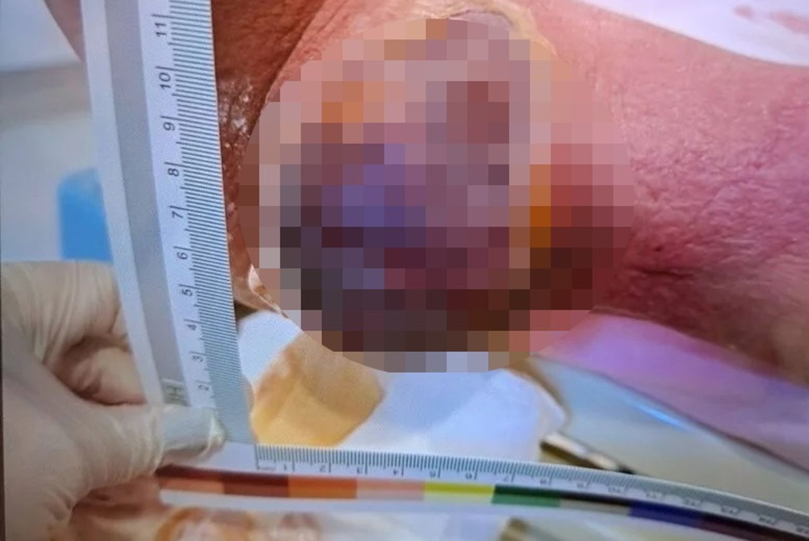 痛風還不忌口！腳踝劇痛滲出白漿　醫師示警嚴重恐截肢保命