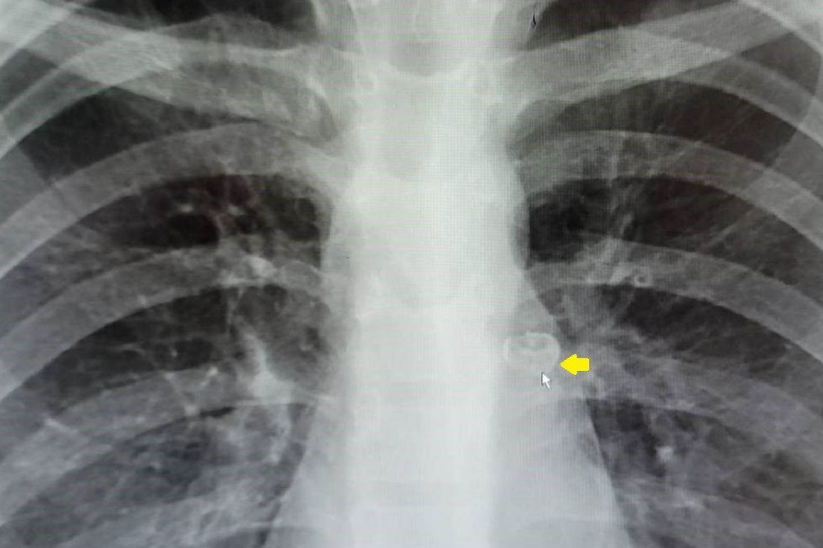 男童綁線拔牙卻找不到牙齒！居然卡支氣管咳不停送急診