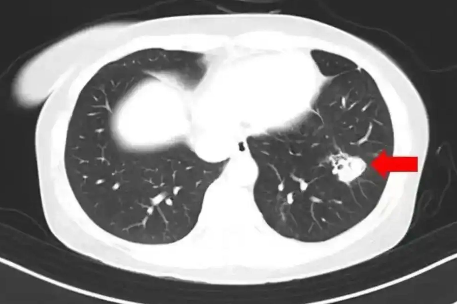 女子肺部長出黴菌。圖／翻攝微博