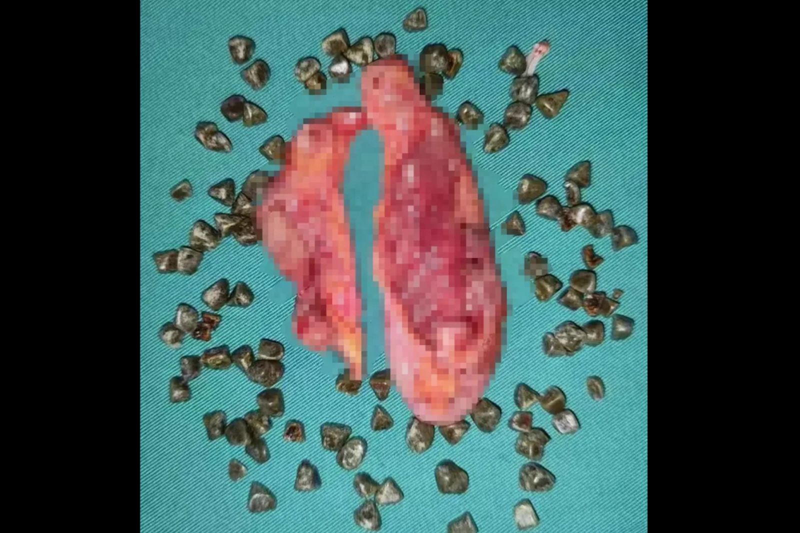 中國一名女子膽囊長滿結石，畫面相當驚人。圖／翻攝自廣州日報